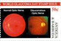 Normal and Glaucomatous Optic Nerves